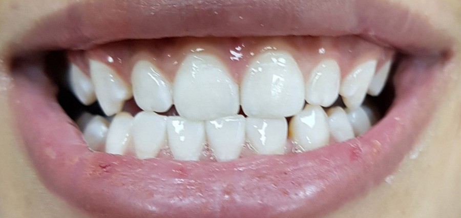 بعد تبيض-ليزر 1 - 1